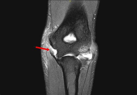 UCL injuries: Defining risk and improving treatment - Mayo Clinic