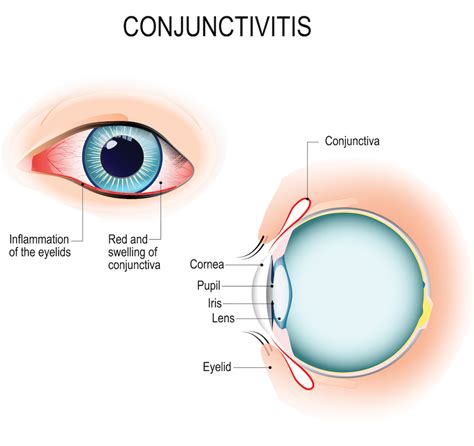 Conjunctivitis | La Pine Eyecare Clinic