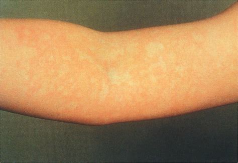 Erythema Infectiousum (Fifth Disease, Slapped Cheek Syndrome) - Dermatology Advisor