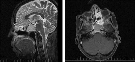 Post‐treatment MRI 1 month after radiation therapy shows decreased ...