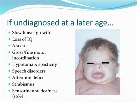 Congenital Hypothyroidism