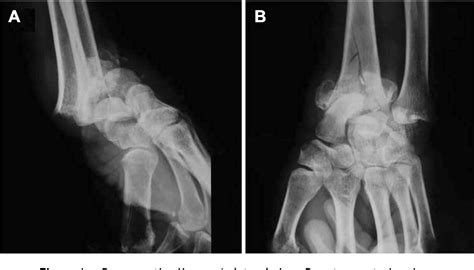 Dislocated wrist | Semantic Scholar