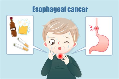 Esophagus Cancer Illustrations, Royalty-Free Vector Graphics & Clip Art - iStock