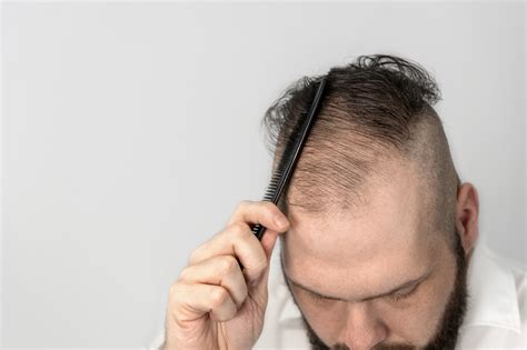 Top 3 Topical Finasteride Myths - Miami Hair Institute