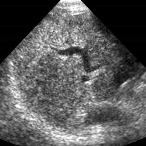 Biliary Hamartoma | Radiology Key