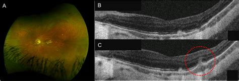 Punctate Inner Choroidopathy. A Left eye ultra-wide field fluorescein... | Download Scientific ...