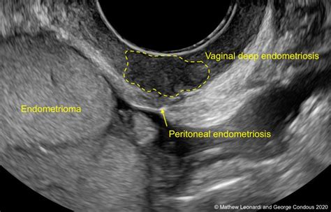 Normal Female Pelvic Ultrasound Images / Http Www Stritch Luc Edu Lumen Meded Obgyne Lectures Us ...