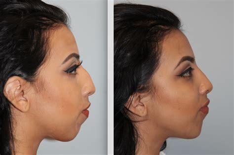 Chin Implant | Daines Plastic Surgery