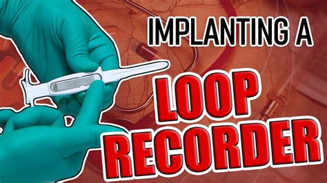 Loop Recorder Implant Procedure - YouTube