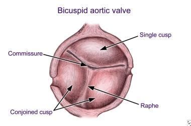 Bicuspid Aortic Valve: Practice Essentials, Background, Pathophysiology