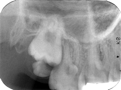 Supernumerary teeth – Dr. G's Toothpix