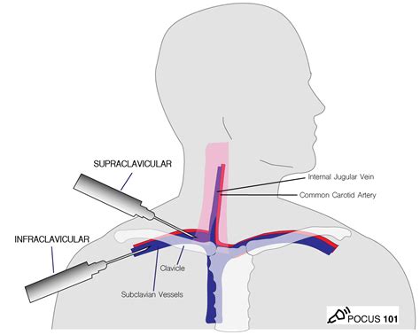 Ultrasound-Guided Central Line Placement Made Easy: Step-By-Step Guide