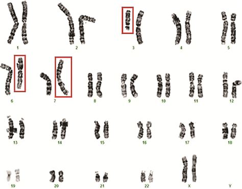 Karyotype of the female patient showing the three-way exchange ...