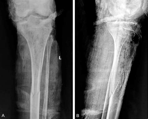 X-ray (A) AP view and (B) Lateral view: Left knee showing... | Download ...