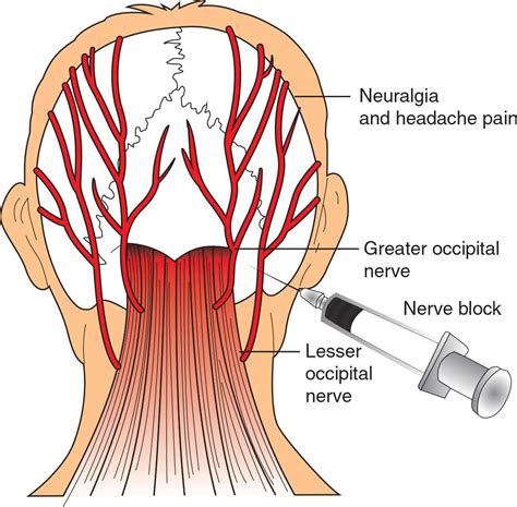 Occipital Nerve Stimulator Occipital Occipital Neuralgia Nerve Anatomy | Images and Photos finder