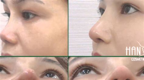 nose cosmetic surgery before and after - YouTube