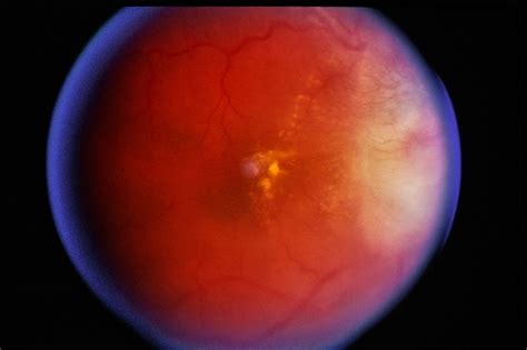 DUSN / Optic Papillitis - Retina Image Bank