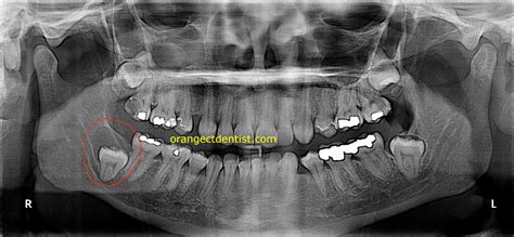 dentigerous cyst - Google Search | Medical transcription, Medical, Cysts