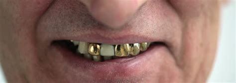 Gold Teeth - Dentist Near Me