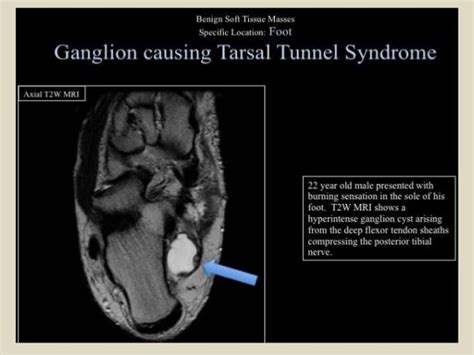 Presentation1 radiological imaging of tarsal tunnel syndrome.