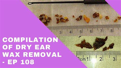 DRY EAR WAX REMOVAL COMPILATION - EP 108 - YouTube