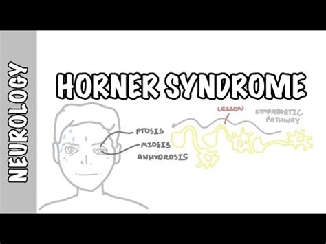 Horner Syndrome - Anatomy, Causes, Pathophysiology, Investigation ...