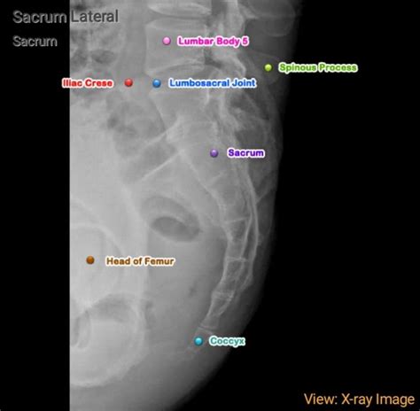 Sacrum Anatomy Xray