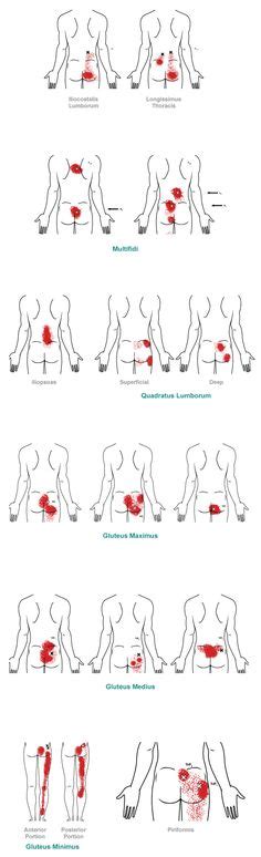 86 Best Sciatica & Groin Relief and Pain Patterns images | Health fitness, Sciatica, Functional ...