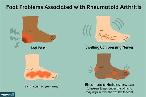 Schmerzen in den Füßen als Symptom der rheumatoiden Arthritis