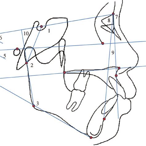 Angular measurements used in study (continued): 11, interincisal angle;... | Download Scientific ...