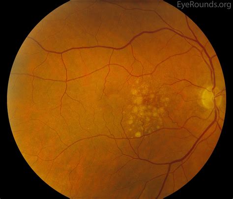 Age-related macular degeneration