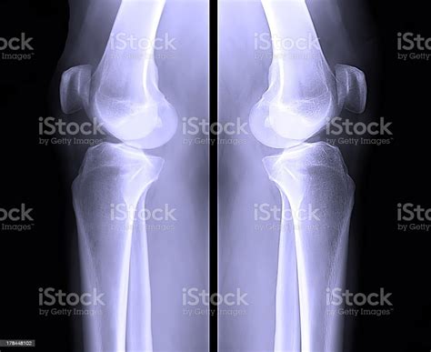 Human Leg Bone Xray Stock Photo - Download Image Now - Anatomy ...