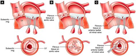 Frontiers | Discrete Subaortic Stenosis: Perspective Roadmap to a ...