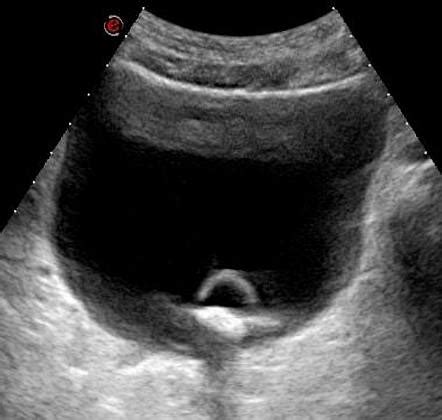 Non-obstructing unilateral ureterocele | Image | Radiopaedia.org