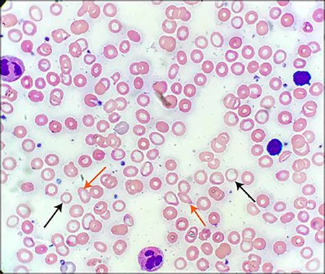 Iron Deficiency Anemia Peripheral Blood Smear