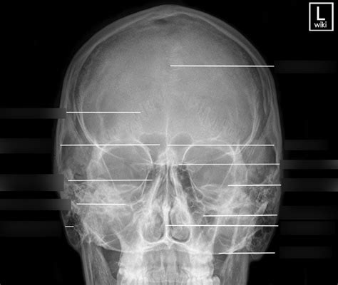 Facial Bones Diagram | Quizlet