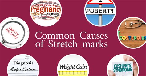 Your Uncut Guide To Stretch-Mark Causes And Solutions