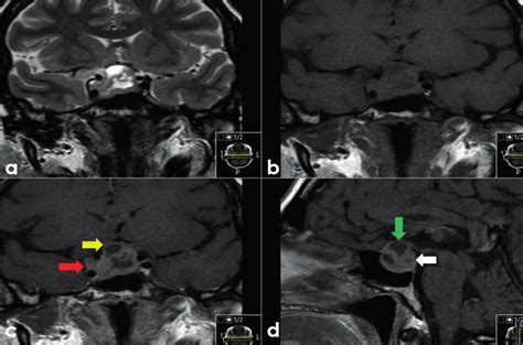 Pituitary adenoma in a 45-year-old woman with a snowman-like shape ...