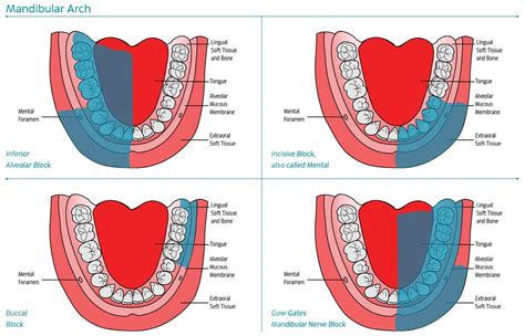 Mandibular Injection Sites | Dental hygiene student, Dental assistant study, Dental hygiene school