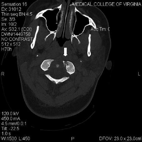 Head CT scan demonstrates a left Type I occipital condyle fracture... | Download Scientific Diagram