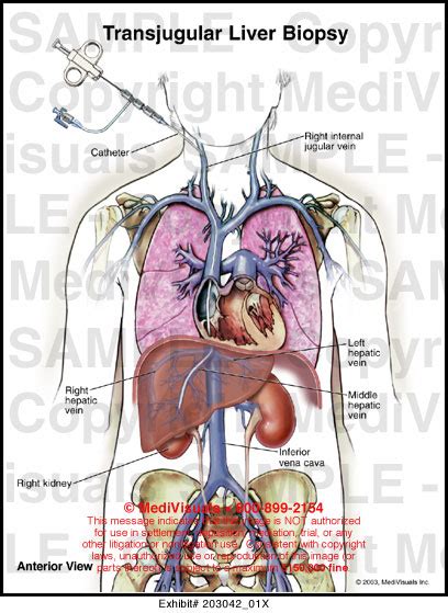 Transjugular Liver Biopsy Medical Illustration Medivisuals