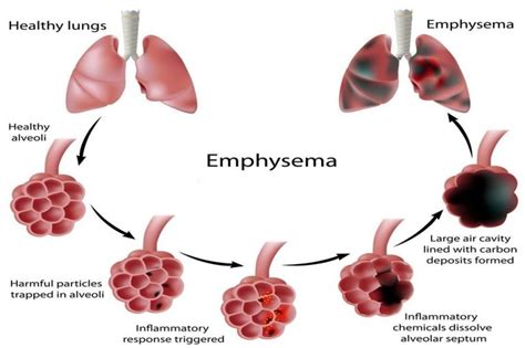 Emphysema : Definition, Symptoms, Causes, Diagnosis, Types, Stages ...