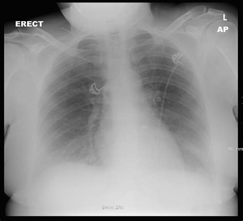 CXR on admission -heart, hilar and mediastinal contours are within... | Download Scientific Diagram