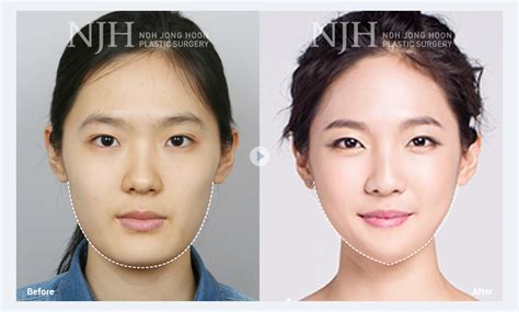 Asian Plastic Surgery Before After