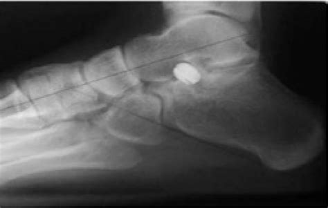 Subtalar Arthroereisis Procedure, Recovery Time, Complications, Contraindications