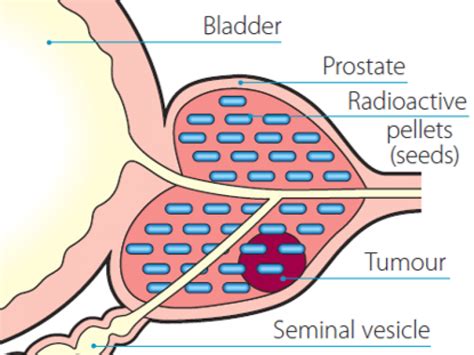 External Beam Radiation For Prostate Cancer Brachytherapy - The Best ...