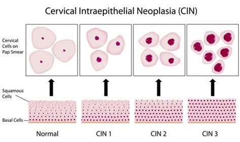 HPV Testing