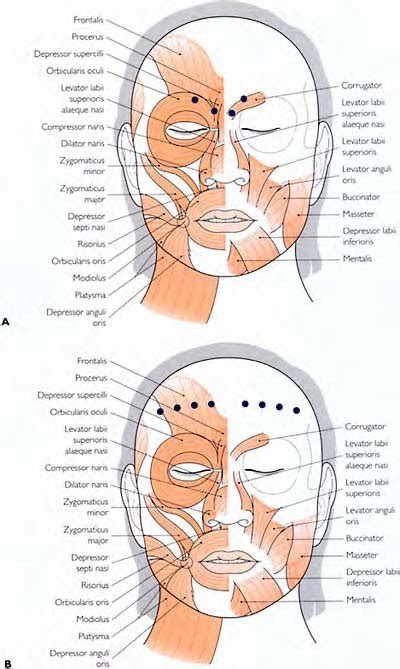 2 Schemata showing the most common sites of botulinum toxin injections ...