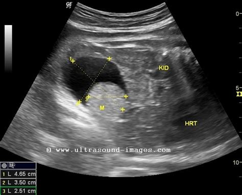 fetal dermoid cyst Dermoid Cyst, Fetal, Ultrasound, Resolutions, Medical, Study, Color, Studio ...