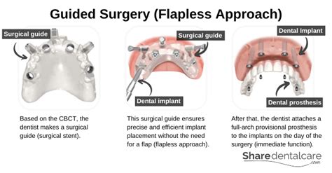 All-on-4 Dental Implants: Smile Back in 1 Day - Share Dental Care